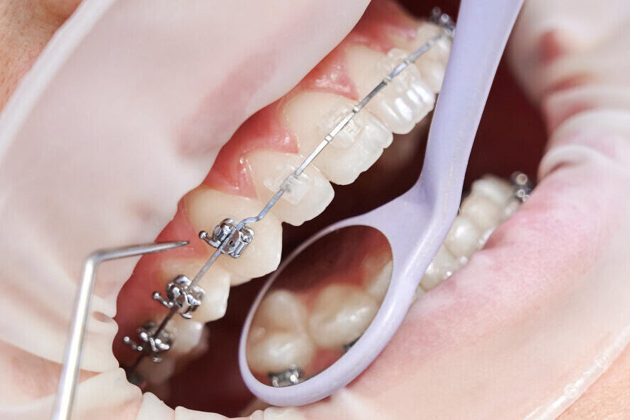 Control ortodontic și ajustarea unui aparat dentar