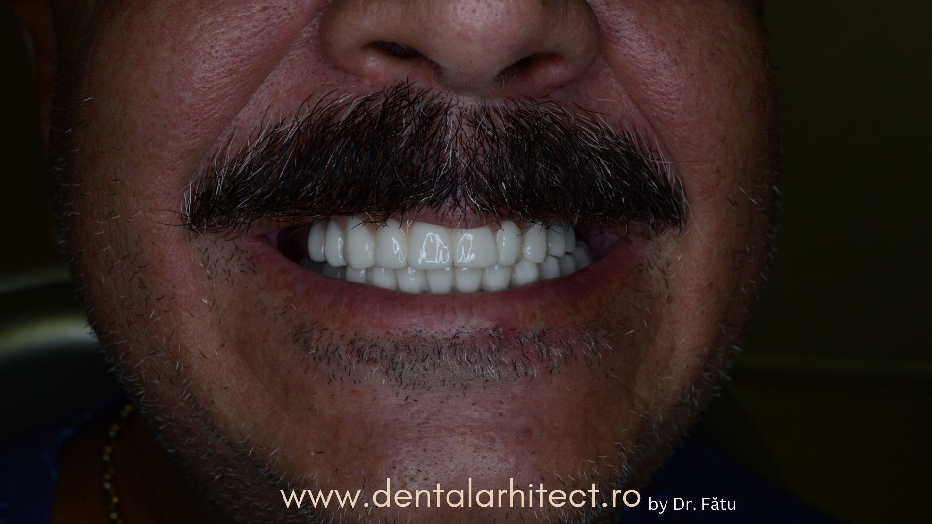 Caz clinic după coroane dentare din zirconiu