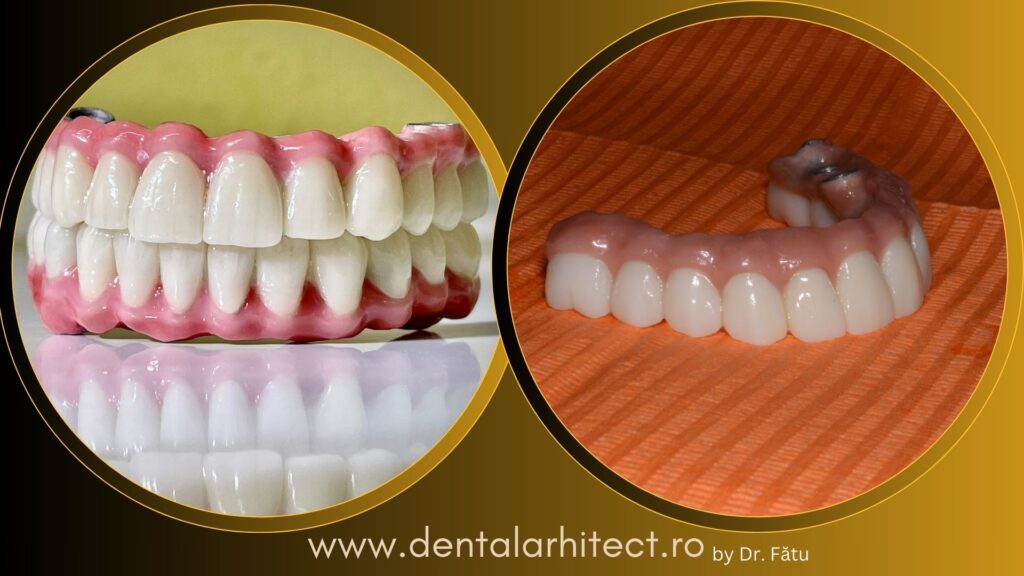 Lucrare provizorie fixă pe implanturi dentare