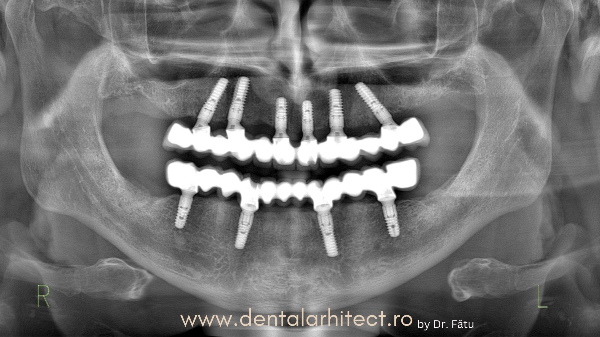 Tratament cu implant dentar în București