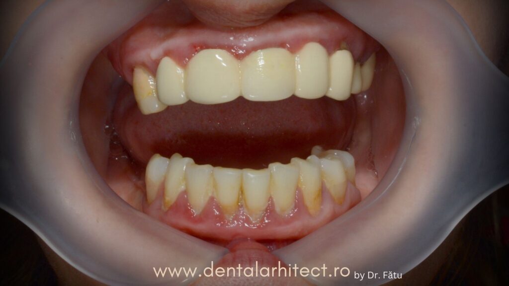 Coroane dentare vechi înainte de tratament