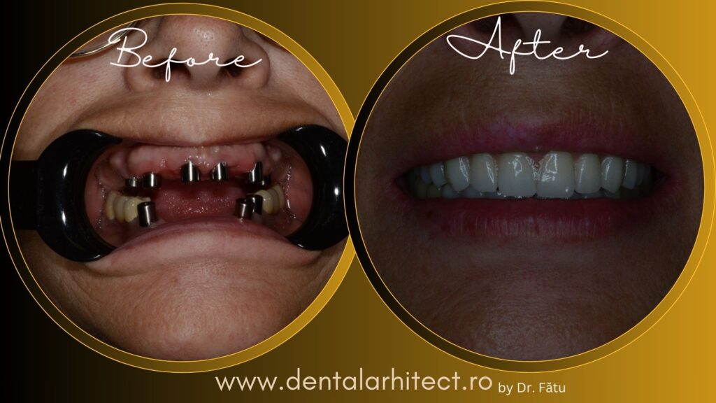 Coroană individuală pe implant dentar