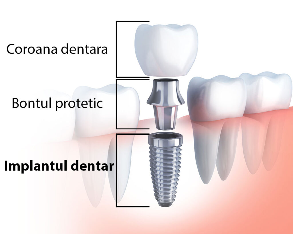 Etapele inserării unui implant dentar