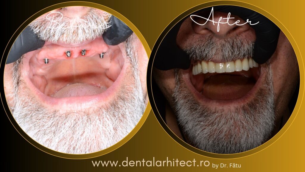 Punte dentară susținută de implanturi