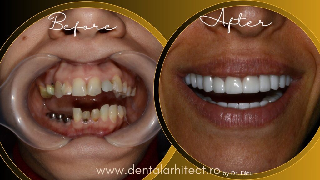 Planificarea tratamentului cu implant dentar