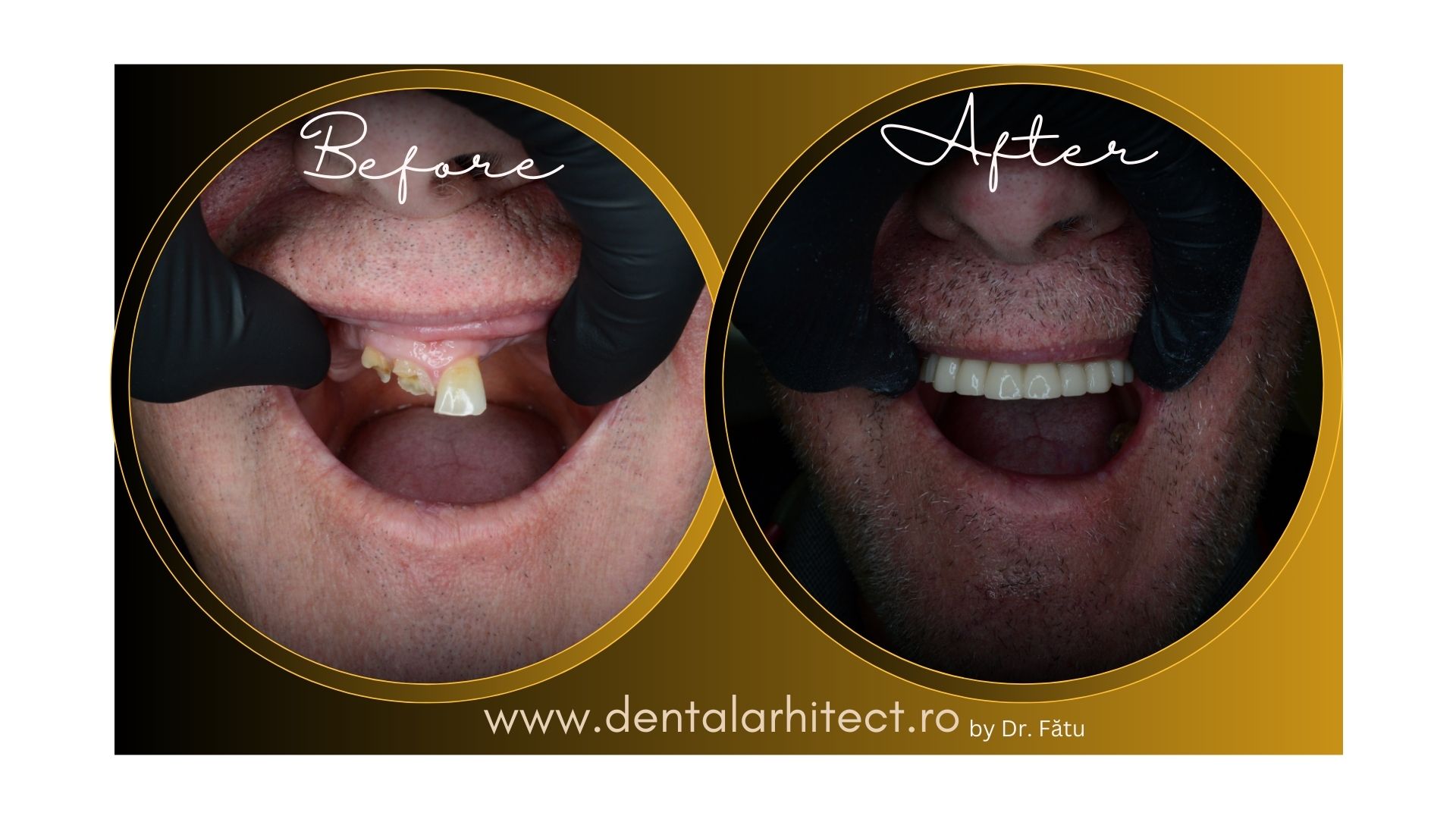 Evaluare pentru implant dentar în București
