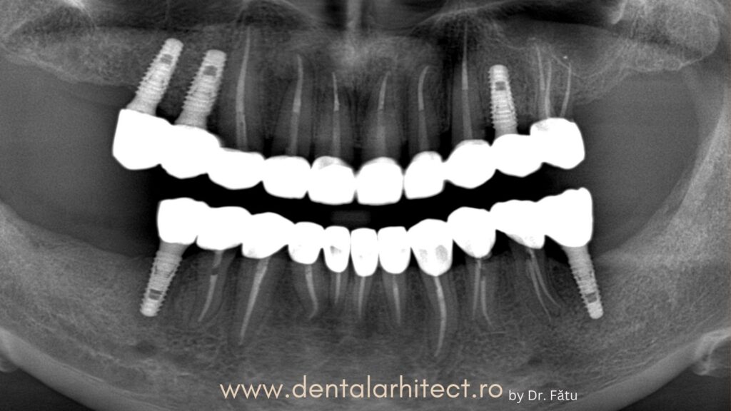 Implant dentar INNO în imagine radiologică