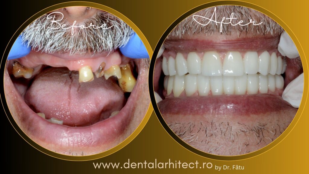 Proteză fixă pe implanturi dentare