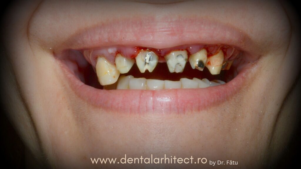 Îndepărtarea coroanelor dentare vechi