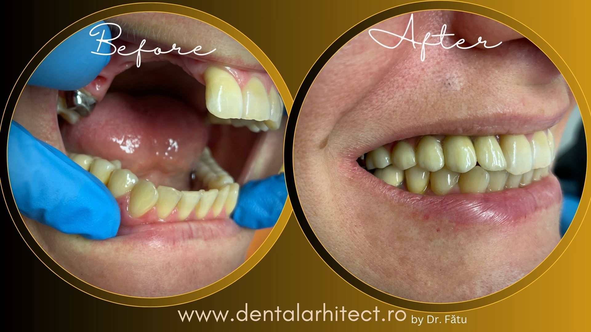 Refacere protetică pe implant dentar