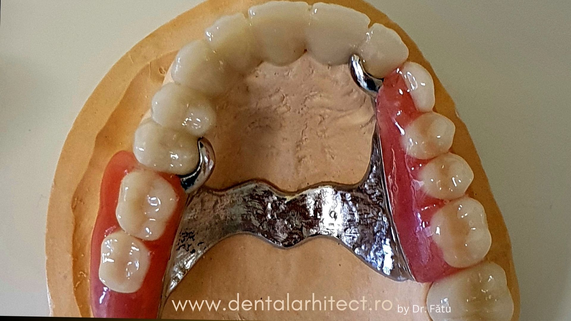Proteză dentară scheletată