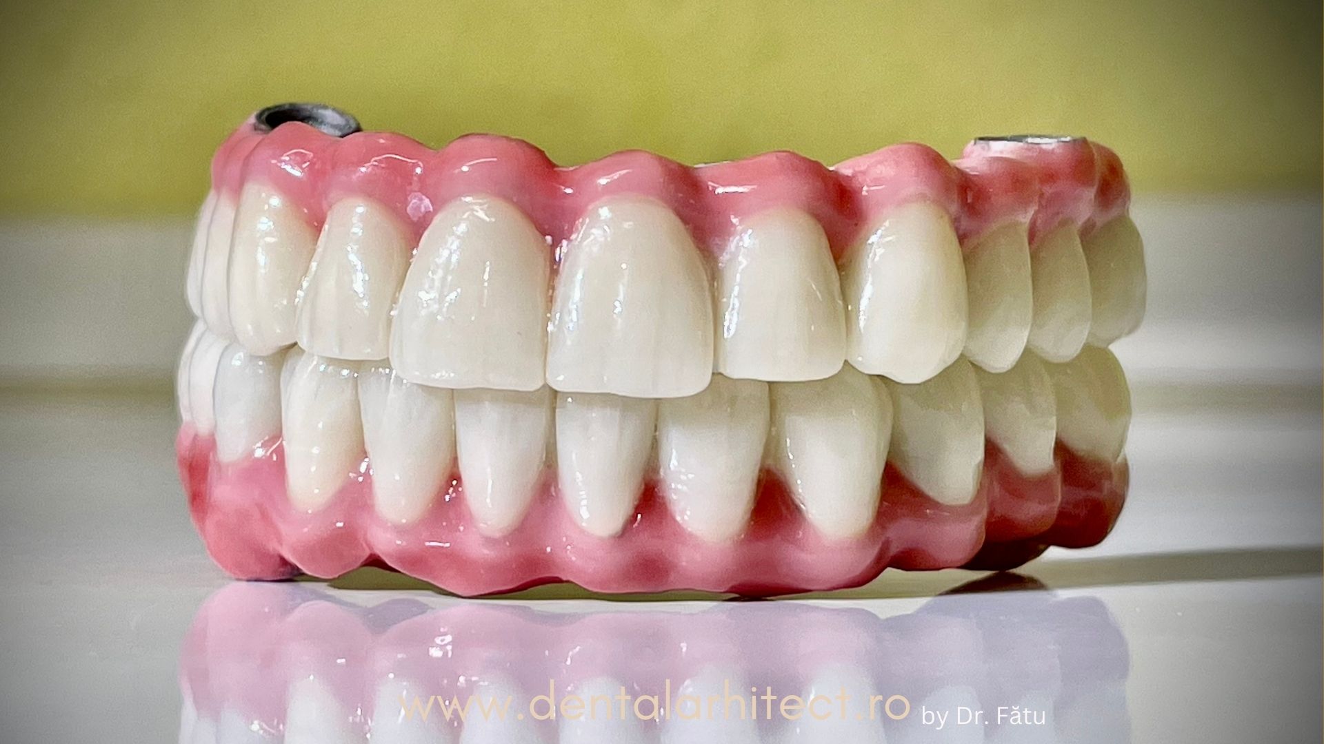 Exemplu de proteză dentară pentru înlocuirea dinților lipsă