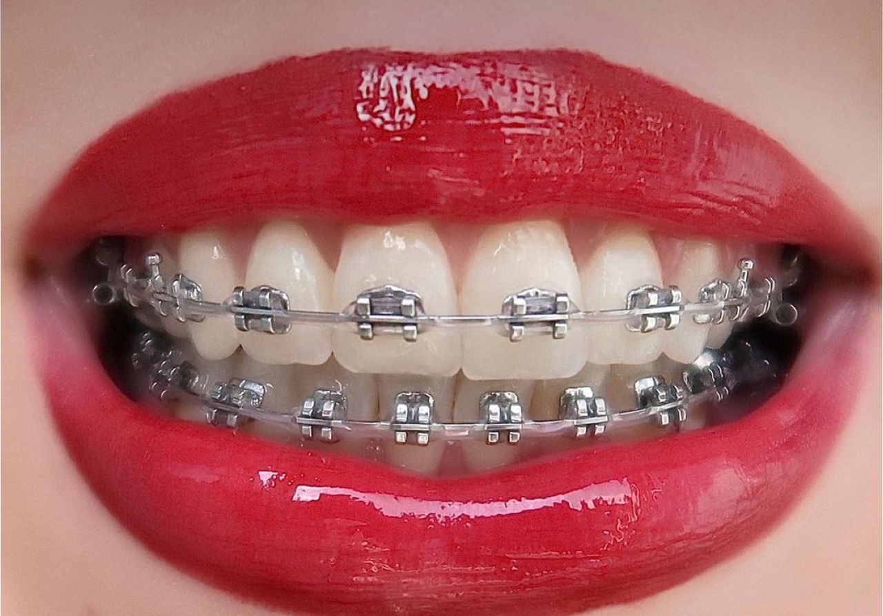 Aparat dentar fix metalic aplicat pe dinți