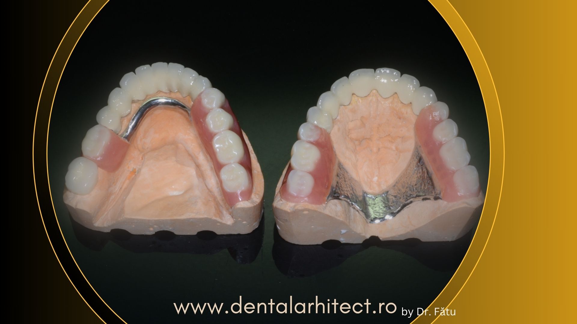 Proteză dentară scheletată cu structură metalică