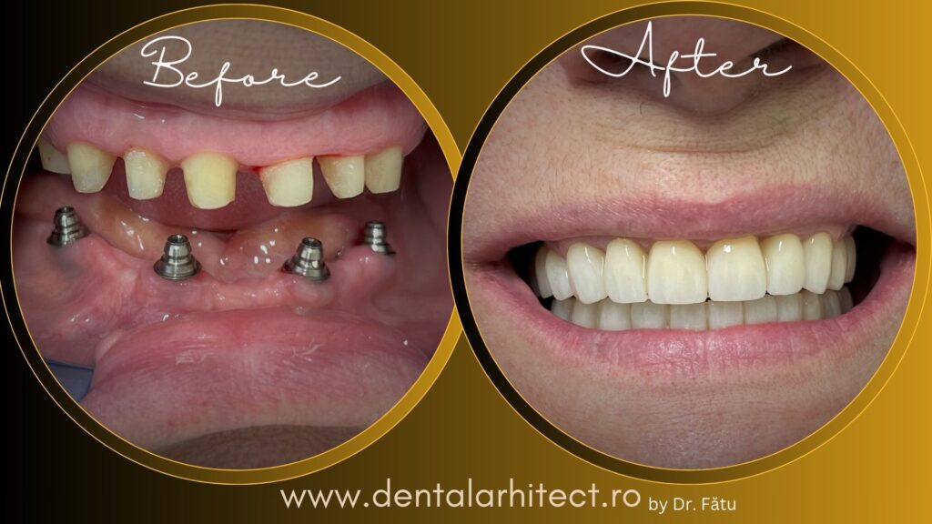 Restaurare dentară – caz clinic