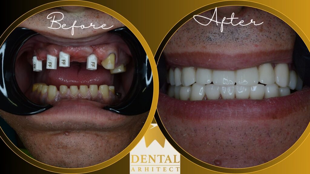 Coroane din zirconiu – caz clinic