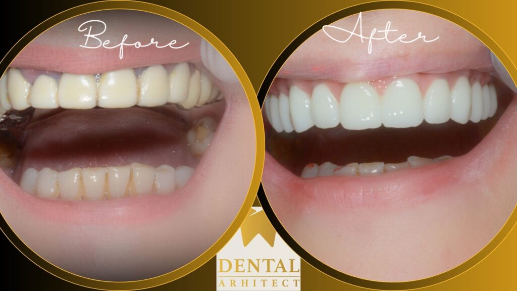 Caz clinic – restaurare cu coroane din zirconiu