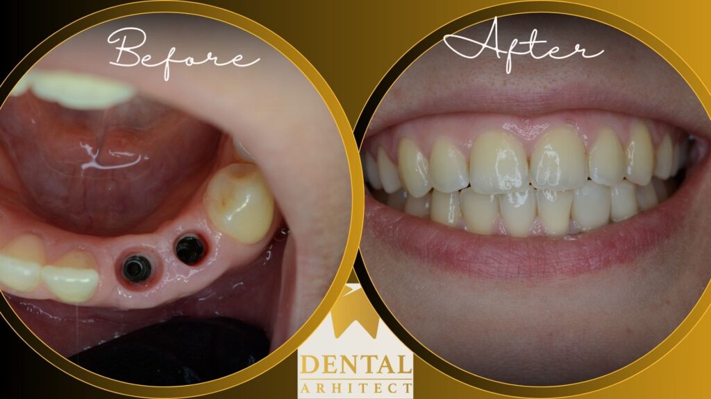 Implant dentar – caz clinic în București