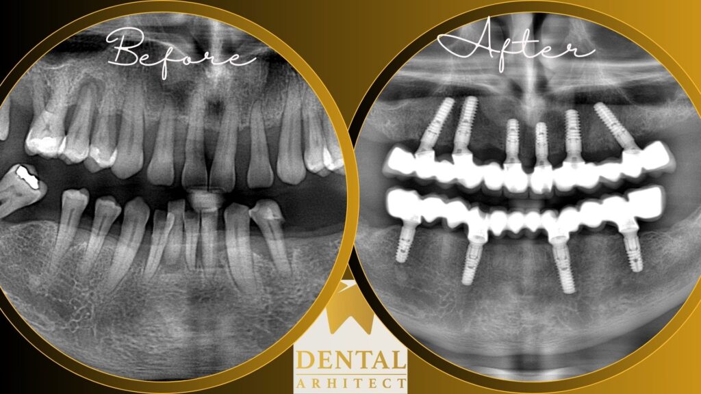 Restaurare extinsă cu implanturi dentare