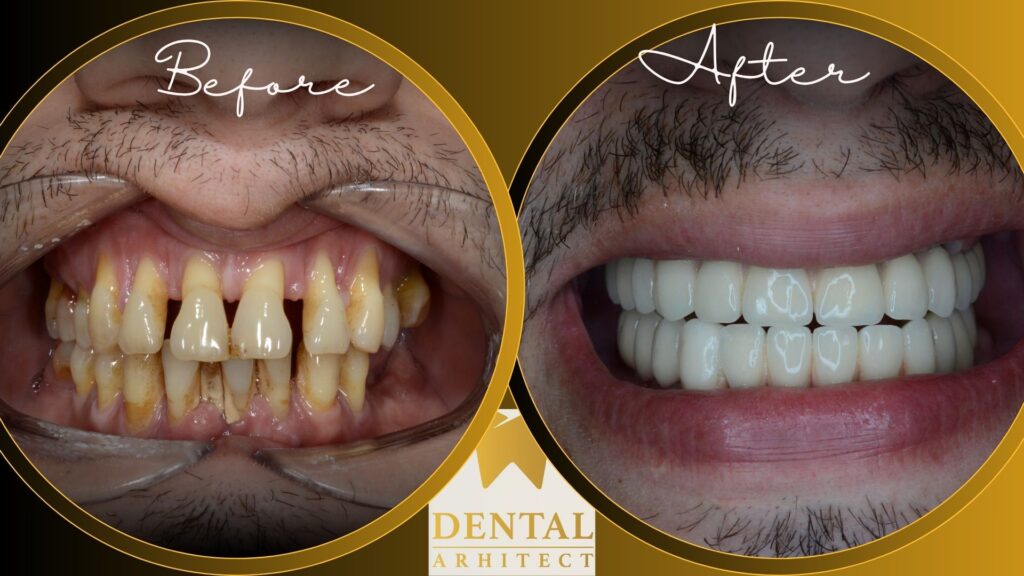 Implanturi dentare – imagine clinică