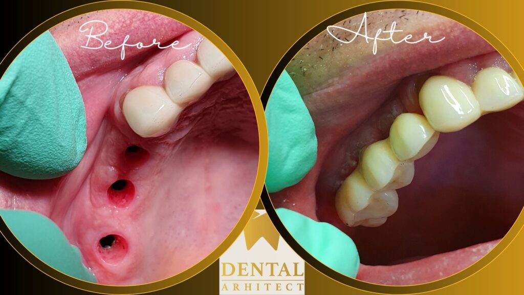Implanturi dentare într-un plan de restaurare