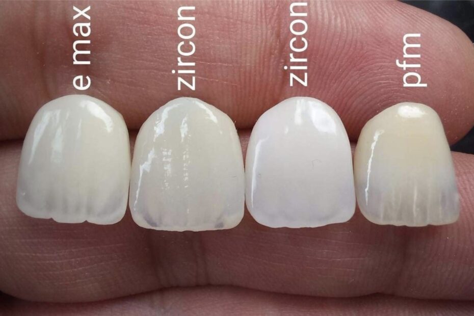 Costul unei coroane dentare în funcție de material