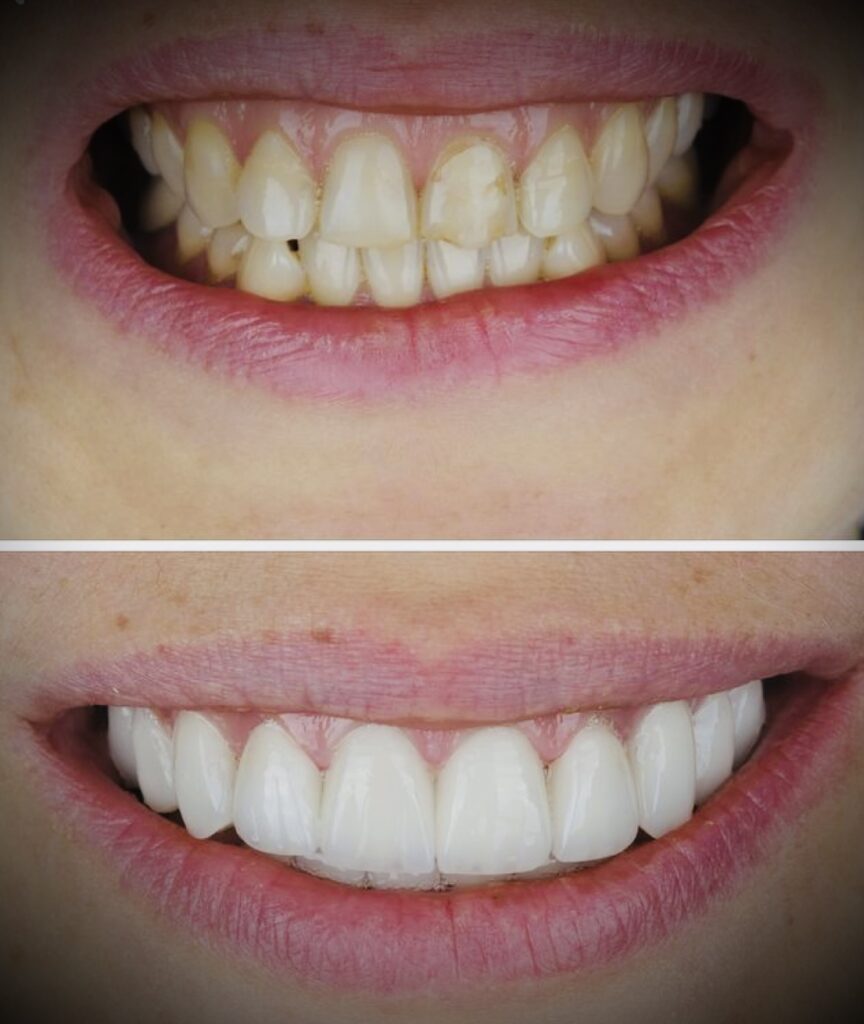 Coroană dentară ceramică realizată în laborator