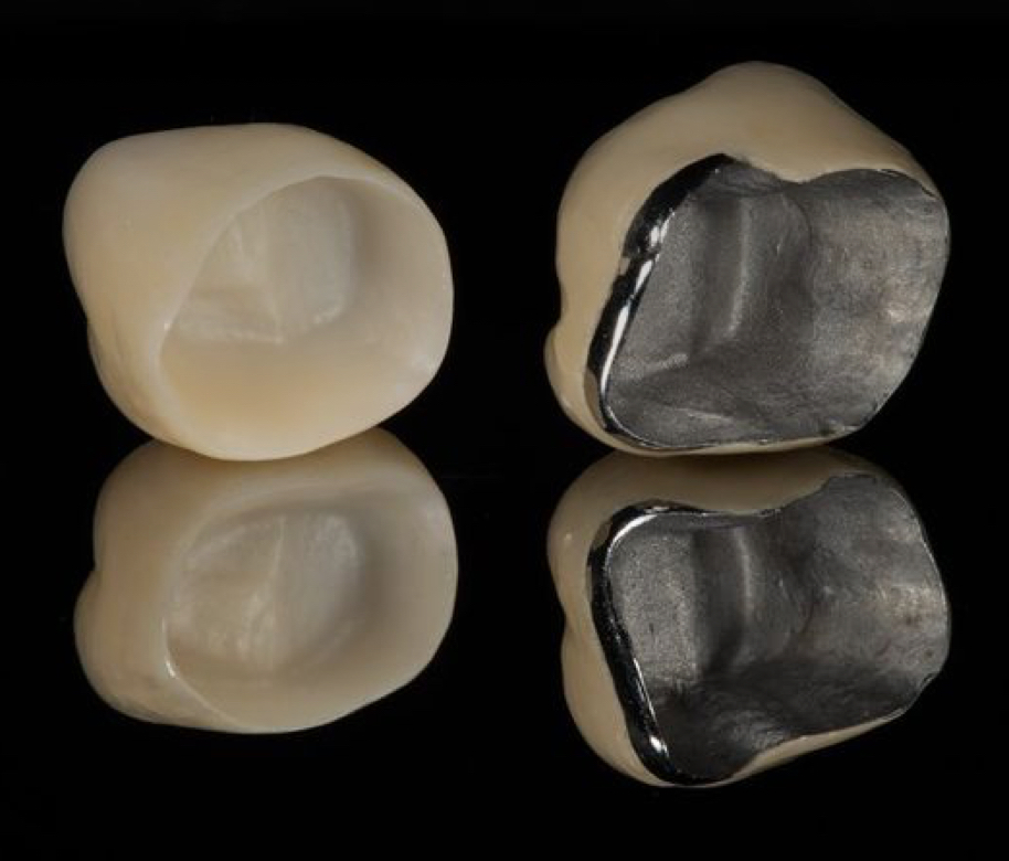 Comparație între o coroană din zirconiu și una metalo-ceramică