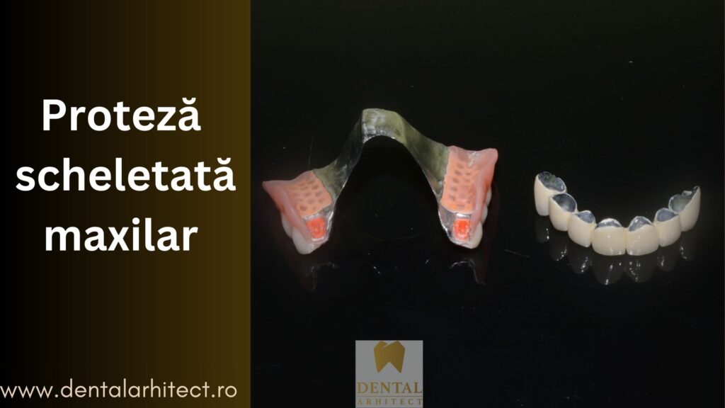 Proteză dentară scheletată pentru edentație parțială