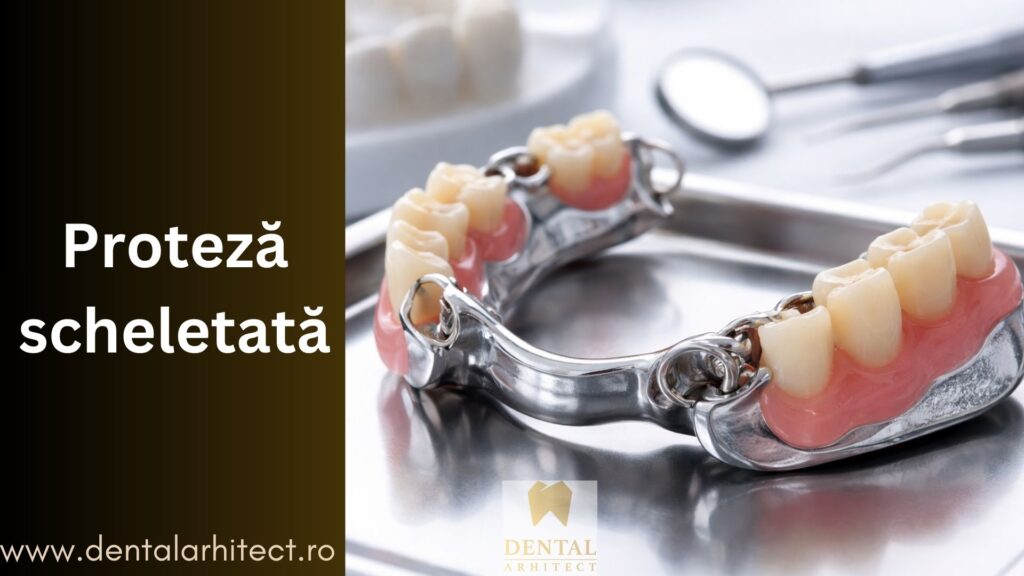 Exemplu de proteză dentară scheletată