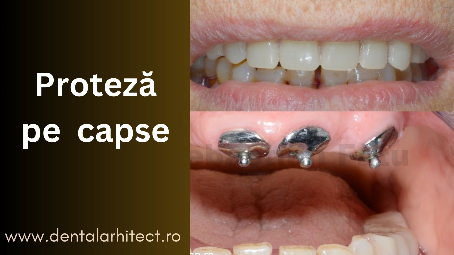 Proteză dentară pe capse DENTAL Arhitect