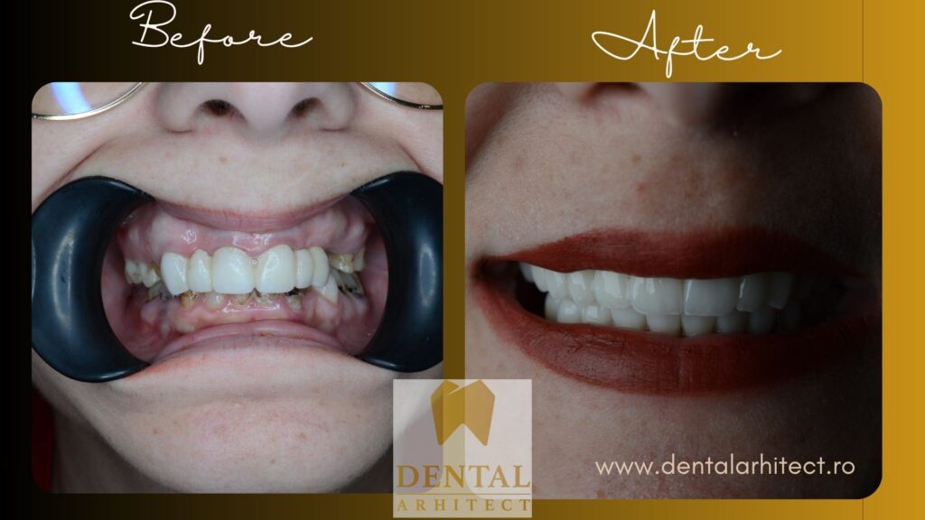 Restaurare dentară din zirconiu