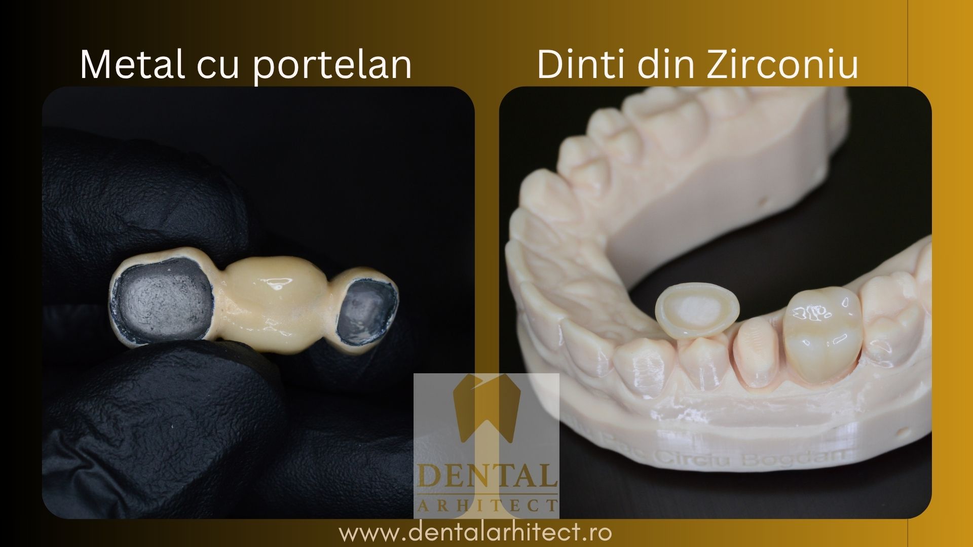 Comparație între coroană metalo-ceramică și coroană din zirconiu