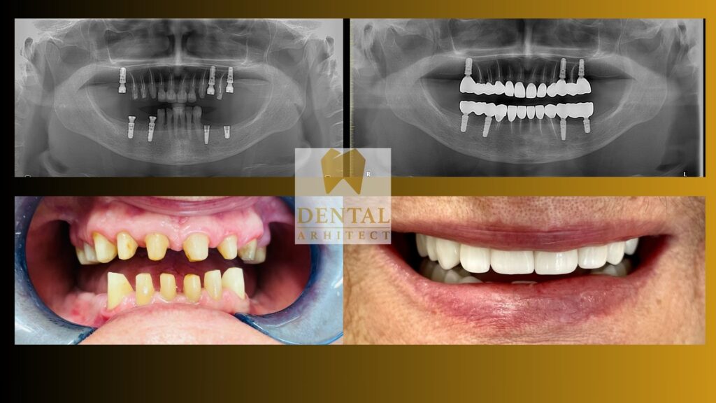 Coroane din zirconiu – exemplu clinic