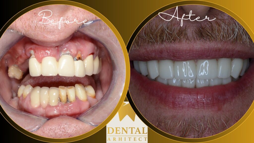 Reabilitare pe implanturi dentare