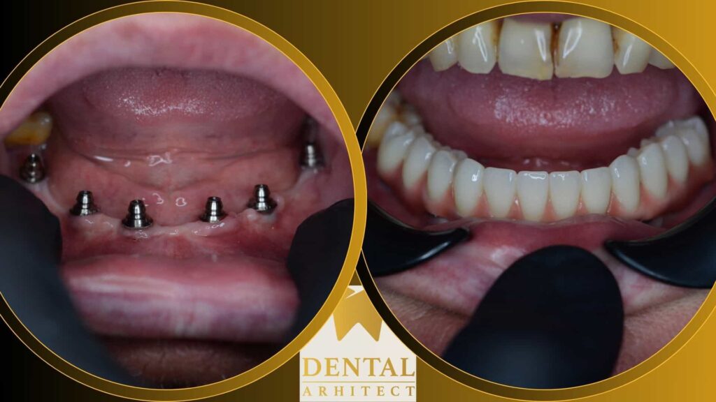 Proteza fixă pe implanturi dentare