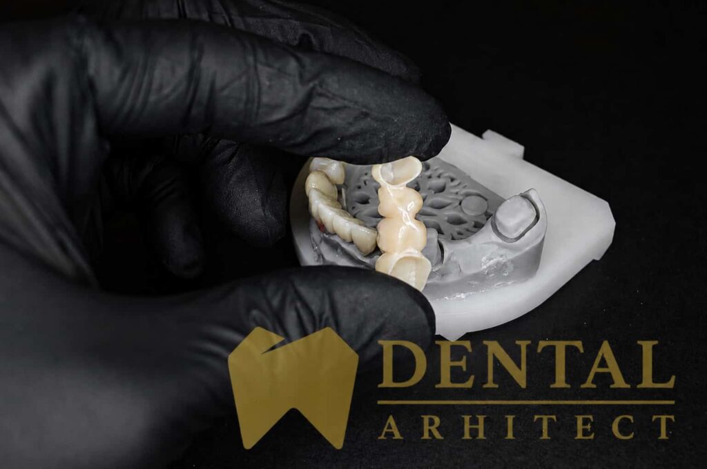 Punte dentară din zirconiu – caz clinic