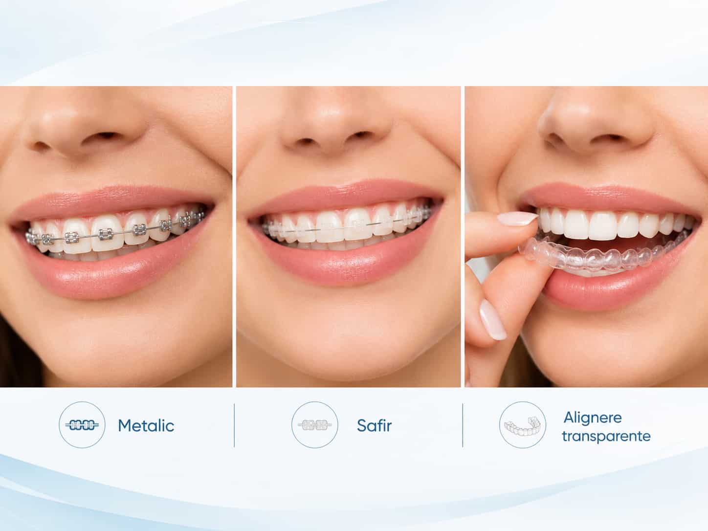 Comparație vizuală între aparat dentar metalic, safir și alignere transparente