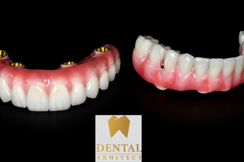Lucrări dentare fixe complete pentru maxilar și mandibulă