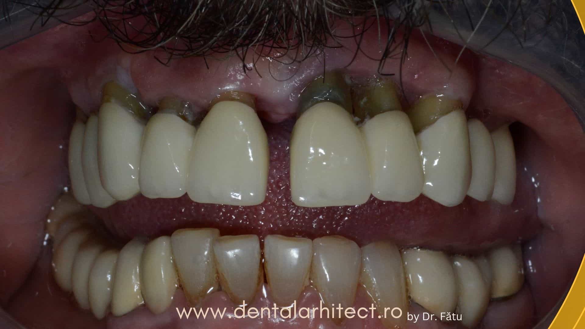 Simptome ale parodontozei: retracții gingivale și afectarea țesuturilor de susținere ale dinților
