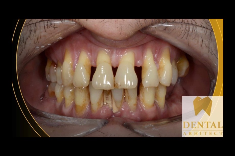 Parodontoză avansată – evaluare și tratament la DENTAL Arhitect, cabinet stomatologic Sector 5