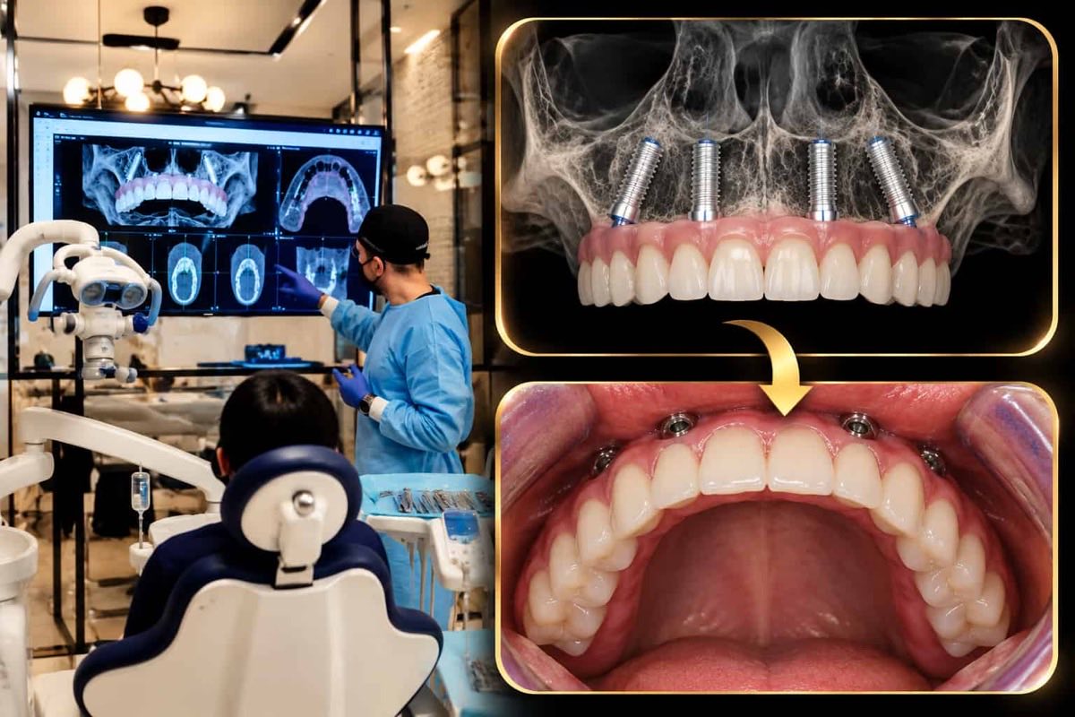 Planificare pentru proteză fără cerul gurii la DENTAL Arhitect