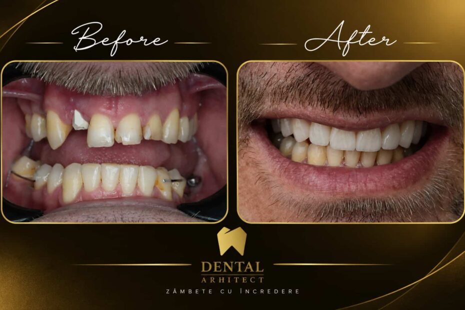 Înainte și după refacerea danturii cu coroane din zirconiu – caz clinic DENTAL Arhitect