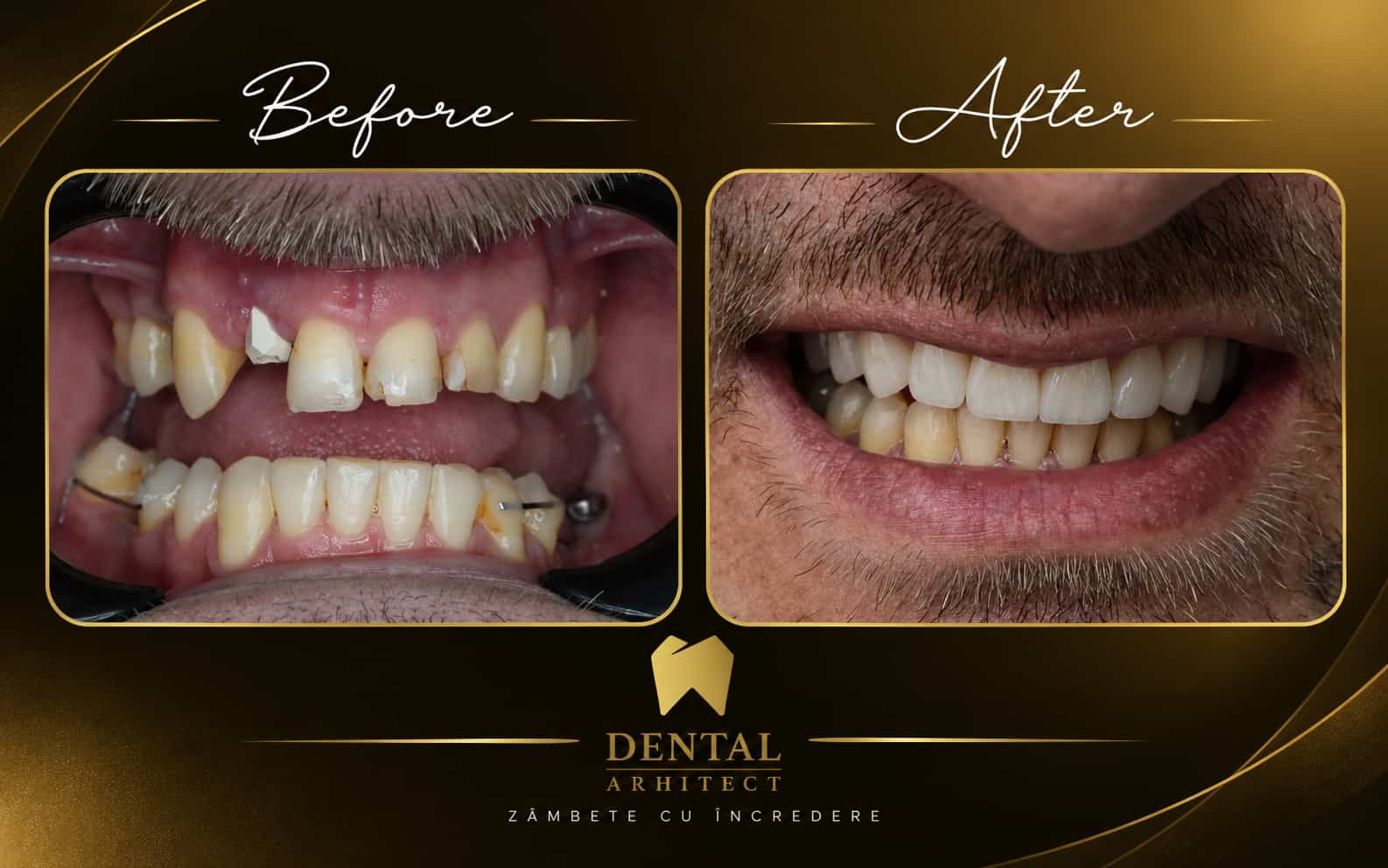 Înainte și după refacerea danturii cu coroane din zirconiu – caz clinic DENTAL Arhitect