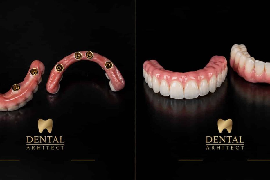 Proteze fixe maxilară și mandibulară pe câte patru implanturi dentare