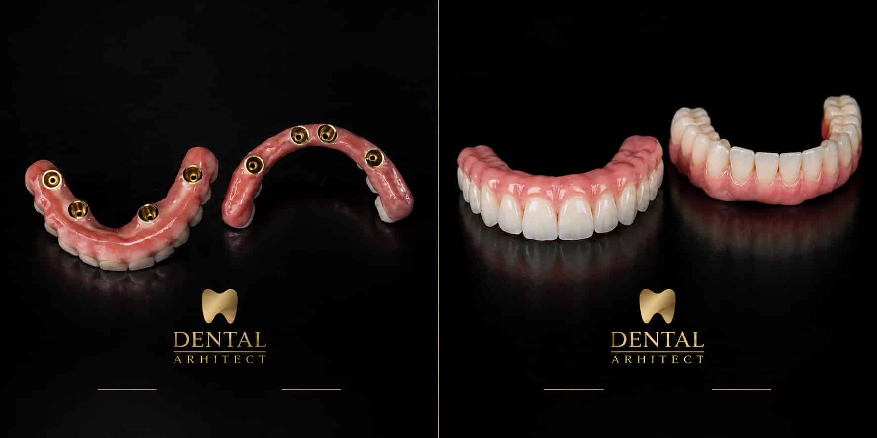 Proteze fixe maxilară și mandibulară pe câte patru implanturi dentare