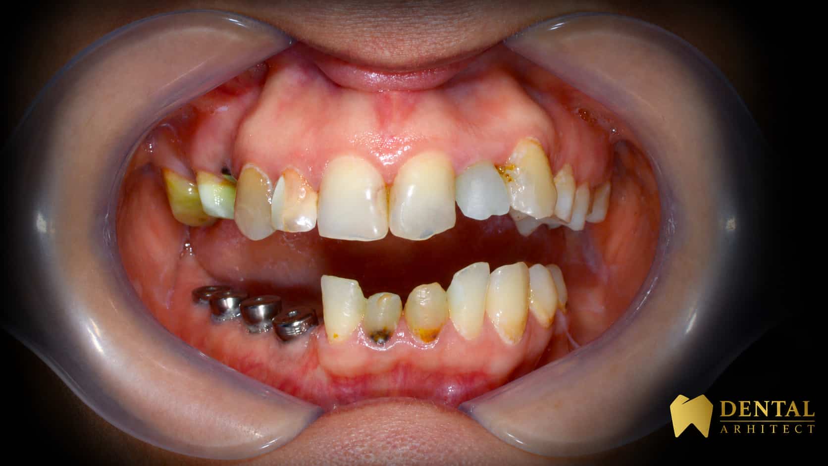 Situația dentară înainte de tratamentul cu coroane din zirconiu