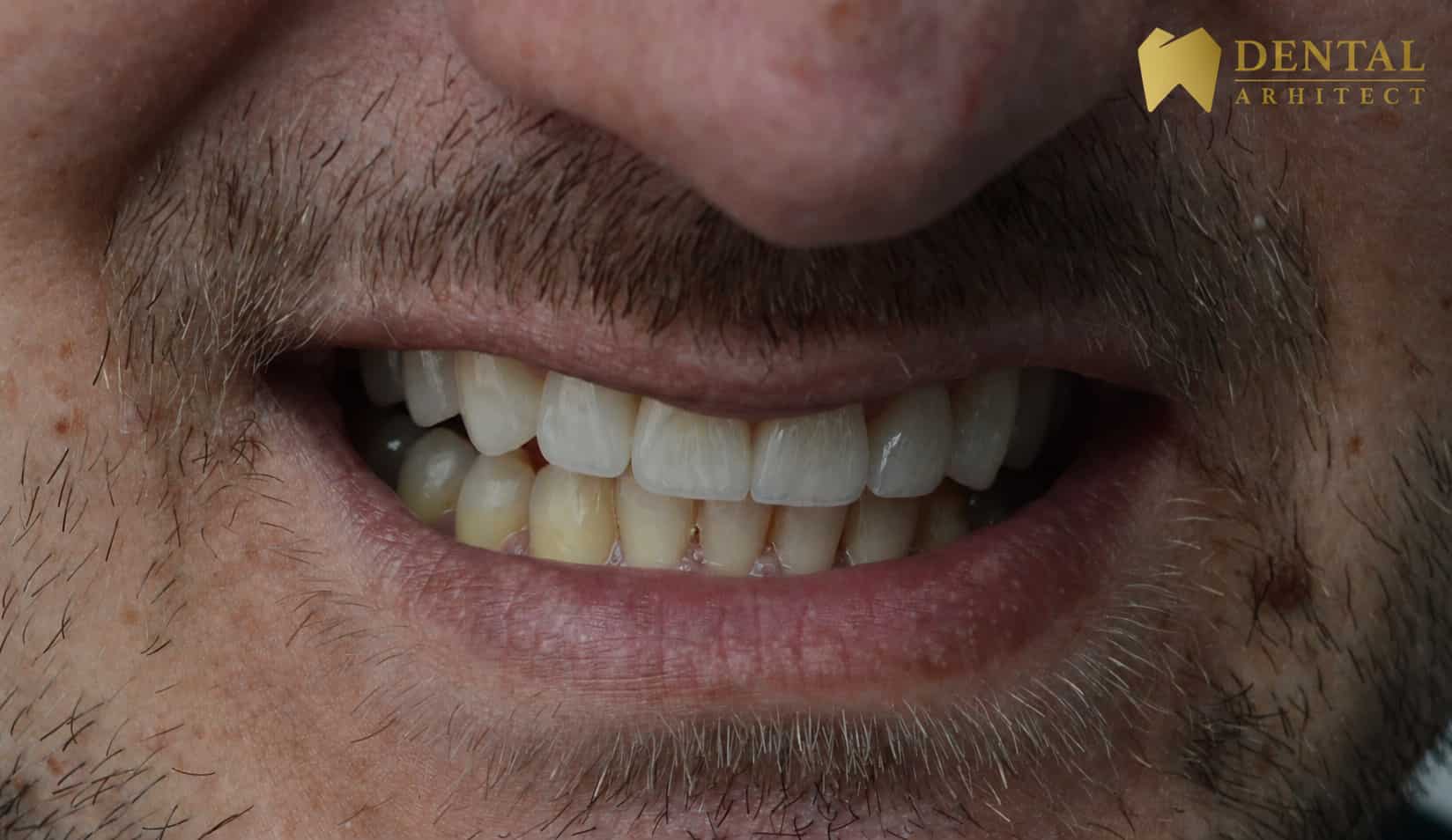 Zâmbet final după tratamentul cu coroane din zirconiu – caz clinic DENTAL Arhitect